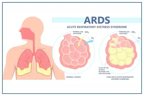 acute respiratory distress syndrome
