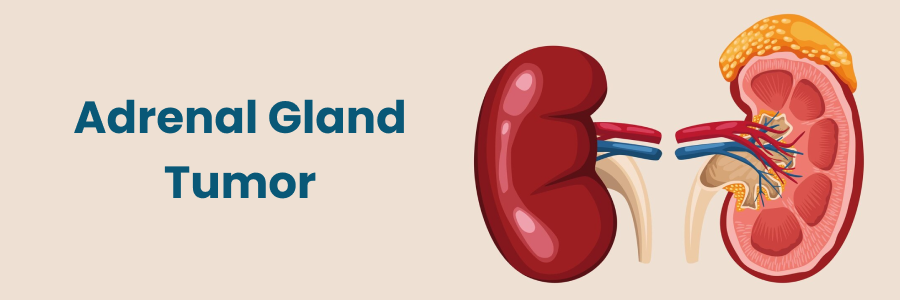 Adrenal Gland Tumor