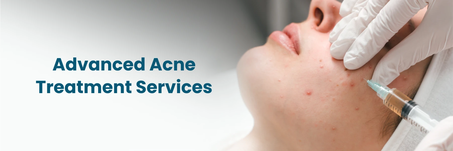 Advanced Acne Treatment Hyderabad