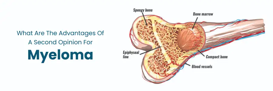 Advantages of Getting a Second Opinion for Myeloma