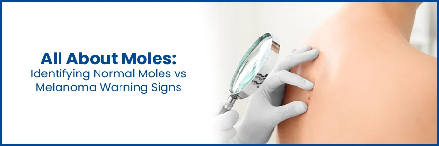 All About Moles: Identifying Normal Moles vs. Melanoma Warning Signs