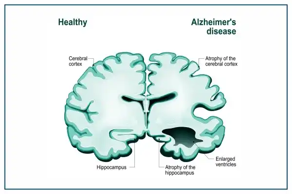 अल्झायमर रोग