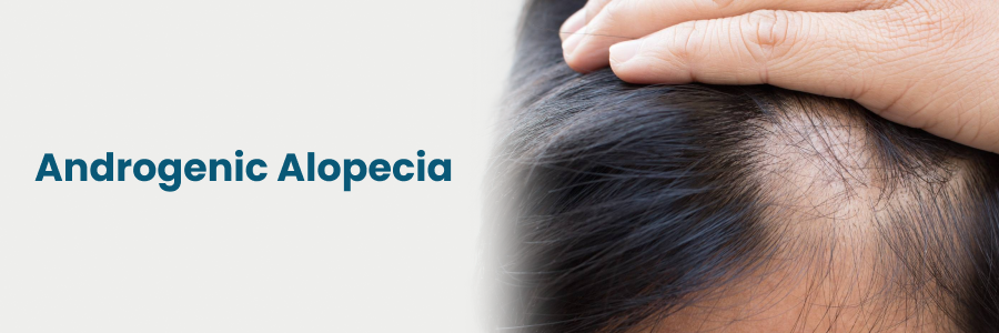 Androgenic Alopecia