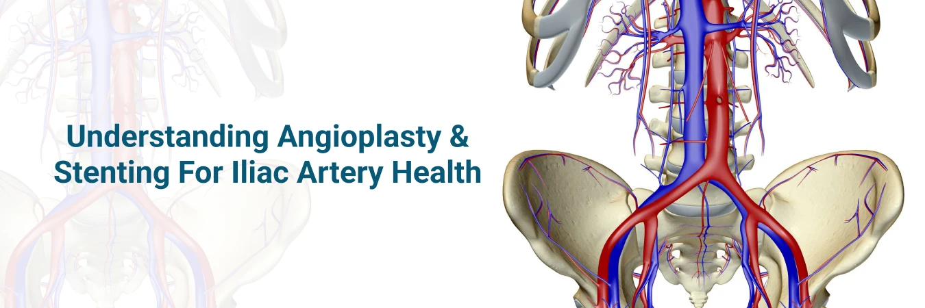 Angioplasty and Stenting