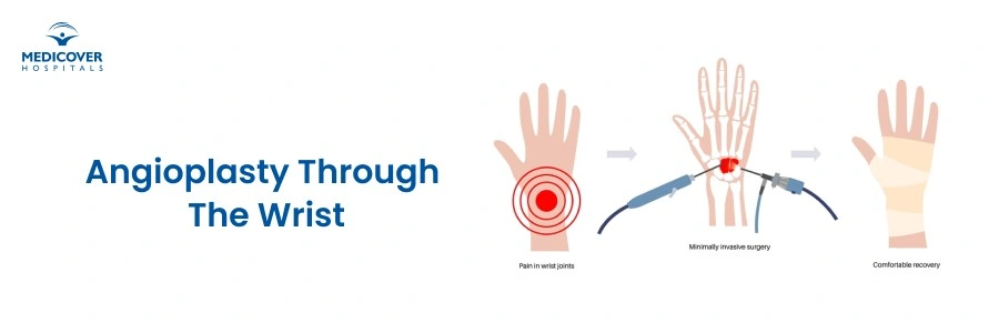 Angioplasty Through the Wrist: Why Radial Access Is Changing Heart Care