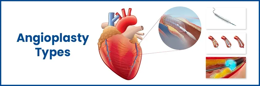 Angioplasty Types and use