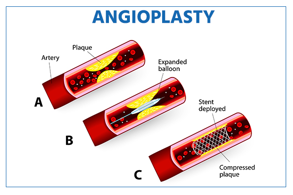 Angioplasty Procedure