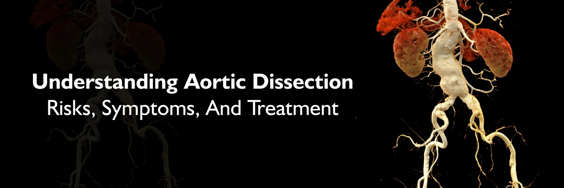 Aortic Dissection