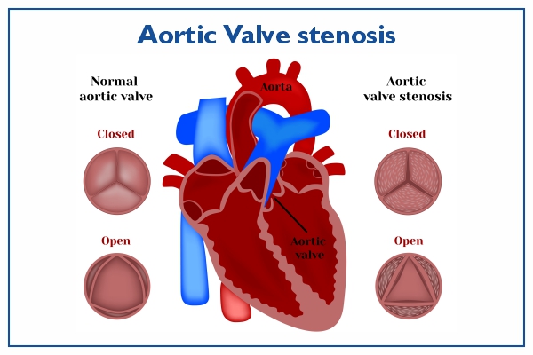 aortic valve replacement surgery