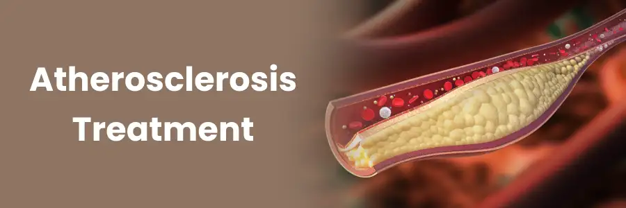 Innovative Atherosclerosis Treatment Options