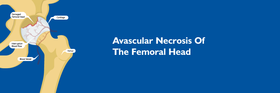 What is Avascular Necrosis Of The Femoral Head (AVN)