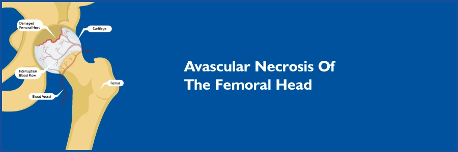 Avascular Necrosis Of The Femoral Head (AVN)