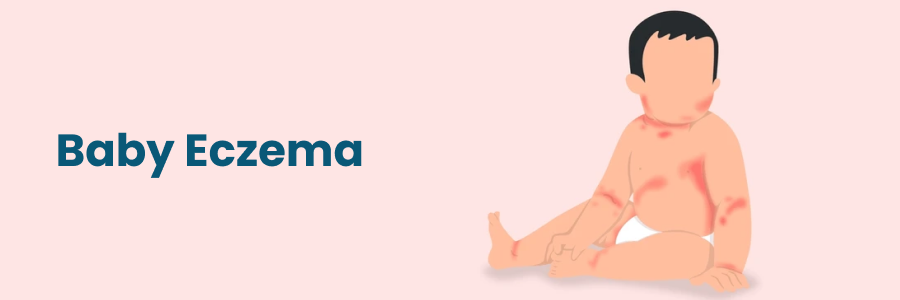 Understanding and Managing Baby Eczema