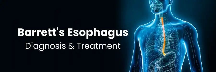 Barrett's esophagus diagnosis and treatment