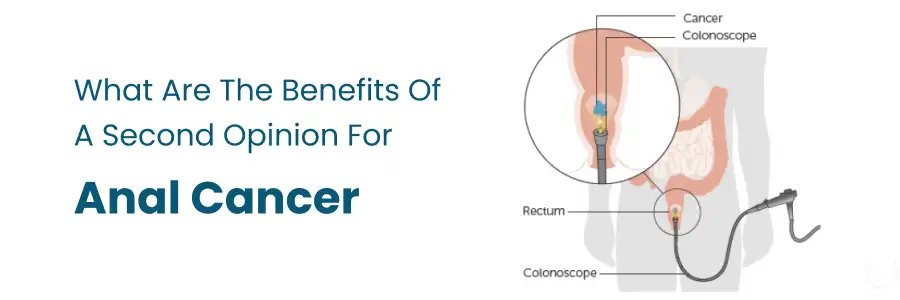Second Opinion for Anal Cancer