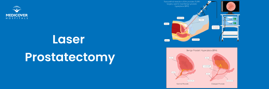 Best Hospital for Laser Prostatectomy Surgery in Kakinada