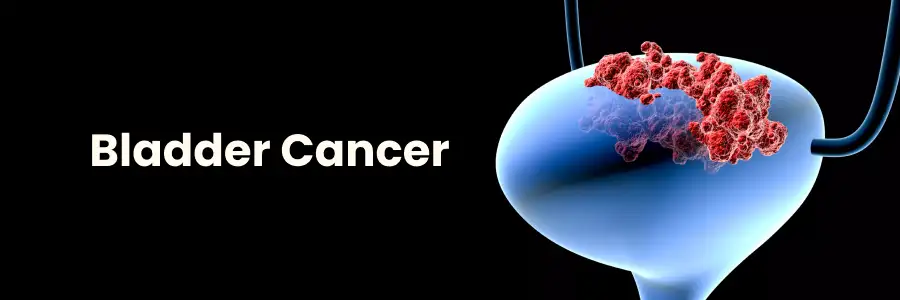Bladder Cancer diagnosis and treatment