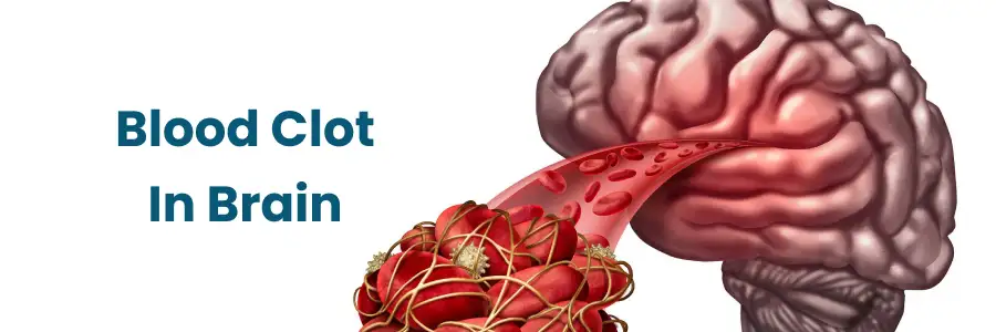 Brain Blood Clot: Symptoms, Risks, Treatments