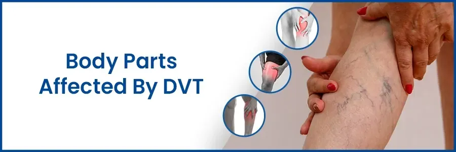 Body Parts Affected By DVT