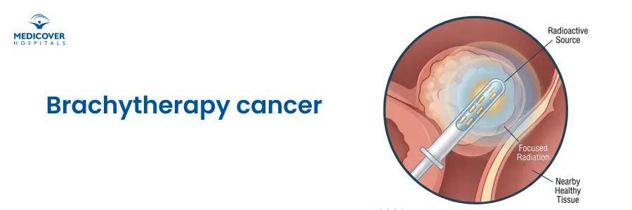 Understanding Brachytherapy: How Medicover Hospitals Treat Cancer in Vizag