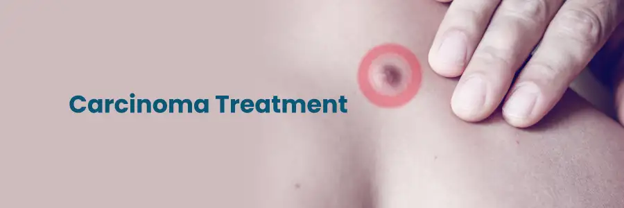 Carcinoma Treatment Hyderabad Carcinoma Treatment Hyderabad
