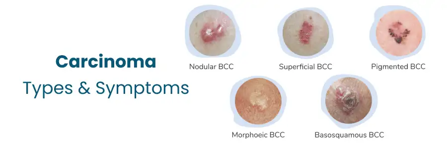 Carcinoma Types Symptoms Vizag