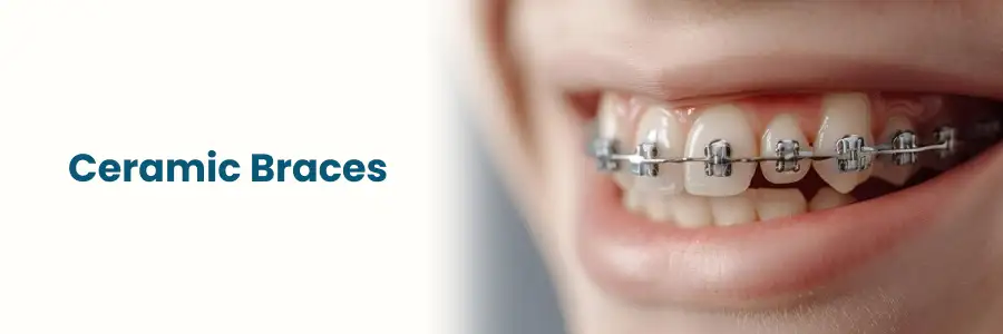 Ceramic Braces