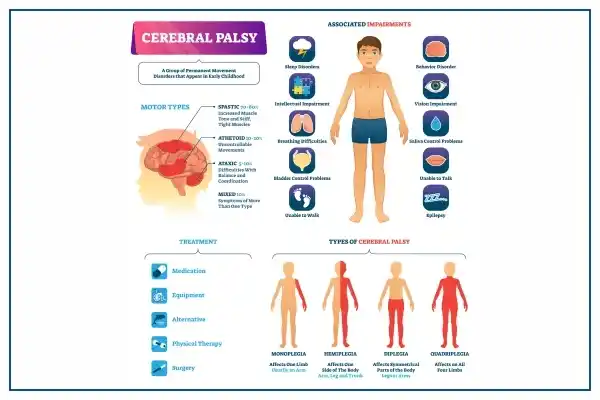 Cerebral Palsy In Children Causes Symptoms Diagnosis cerebral-palsy-in-children-causes-symptoms-diagnosis