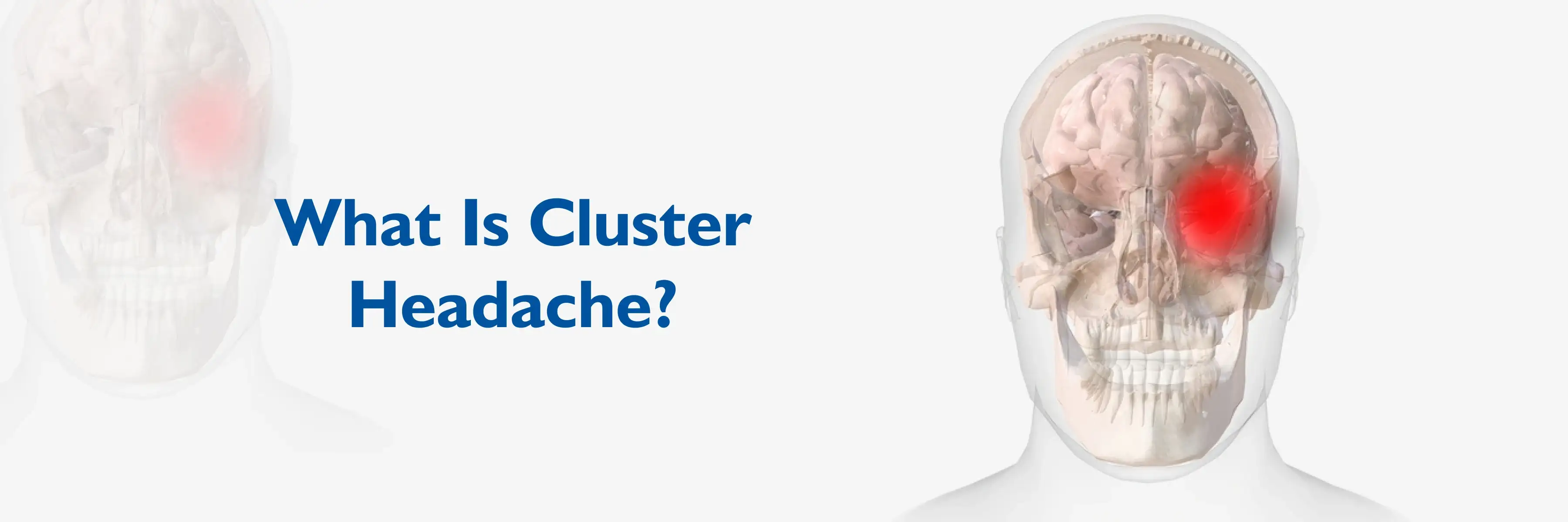 Cluster Headaches
