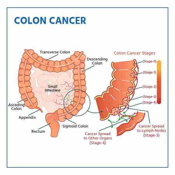 colon-cancer-symptoms