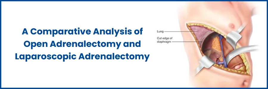 A Comparative Analysis of Open Adrenalectomy and Laparoscopic Adrenalectomy