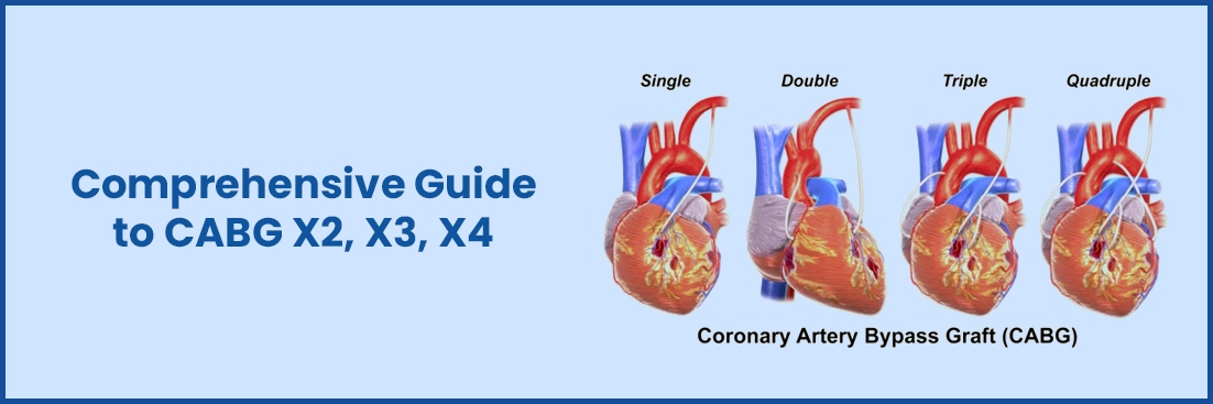 A Comprehensive Guide to the Types of CABG Surgery