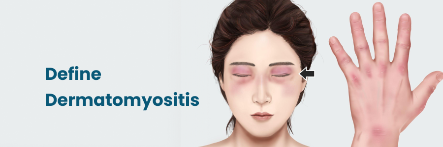 Define Dermatomyositis
