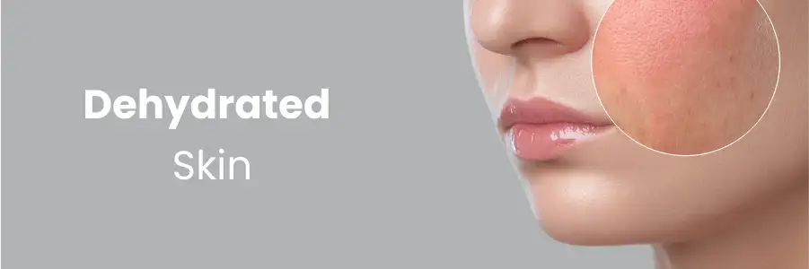Dehydrated Skin