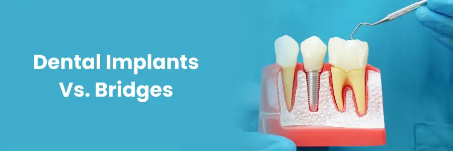 "Dental Implants vs. Bridges: Best Option?"