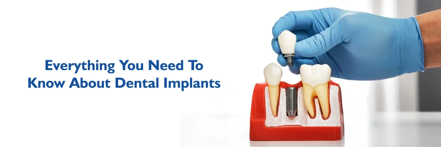 Dental Implants