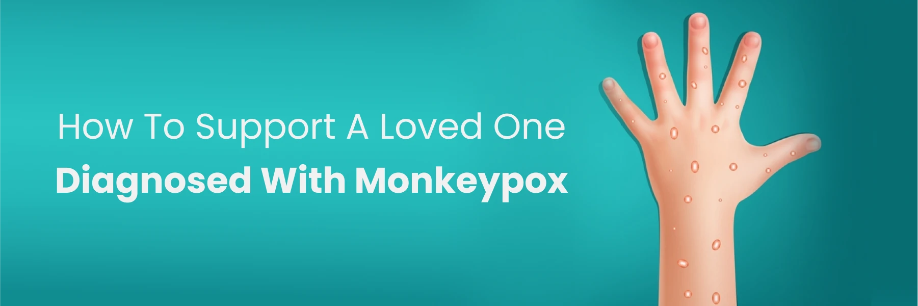 Loved One Diagnosed with Monkeypox