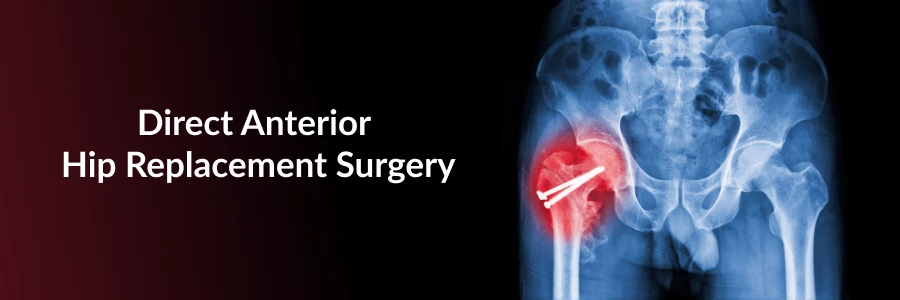 Direct Anterior Hip Replacement Surgery