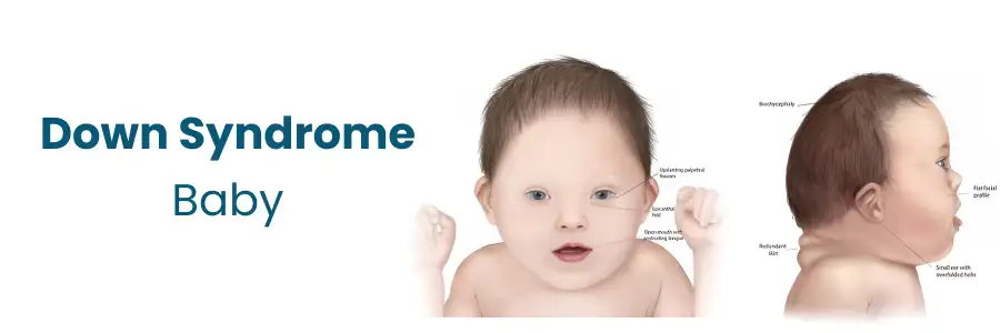 Down Syndrome Baby