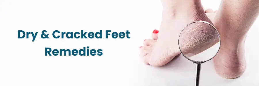 Effective Dry Cracked Feet Remedies