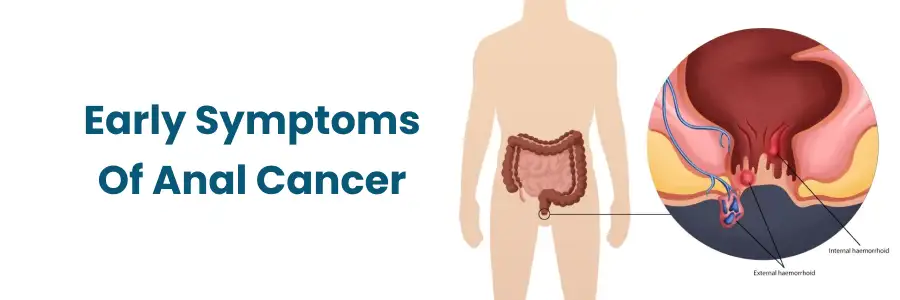 Early Symptoms of Anal Cancer in Vizag Early Symptoms of Anal Cancer in Vizag