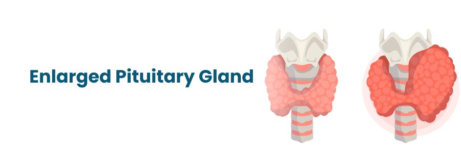 Causes and Symptoms of Pituitary Gland Enlargement