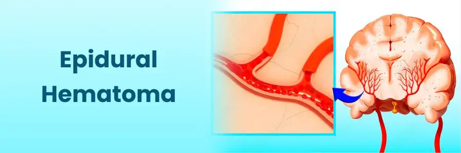 Epidural Hematoma
