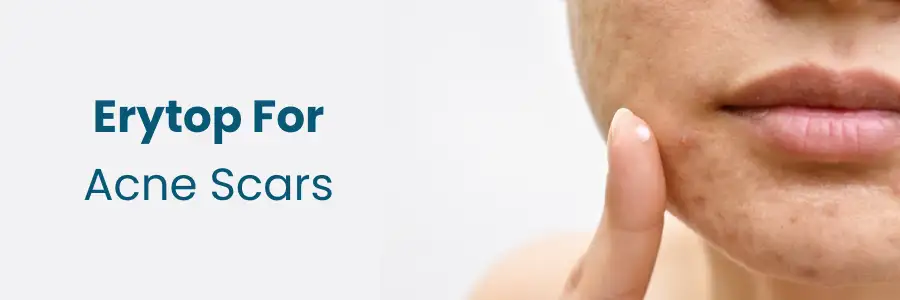 Erytop For Acne Scars
