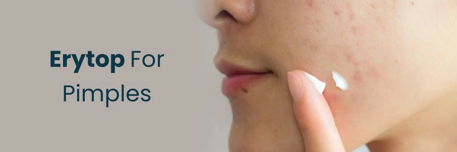Effective Use of Erytop for Acne Treatment