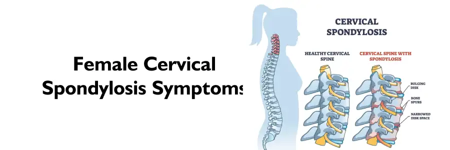 Female Cervical Spondylosis Symptoms