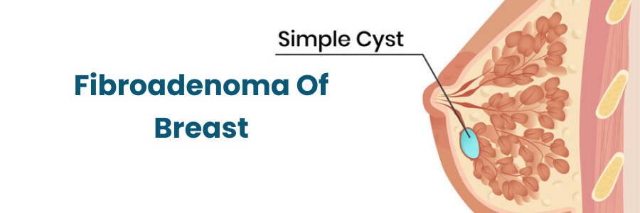 Fibroadenoma Of Breast