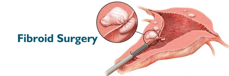 Fibroid surgery