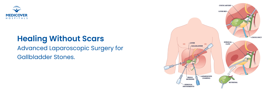gallbladder-stone-pain-free-surgery-success-story gallbladder-stone-pain-free-surgery-success-story