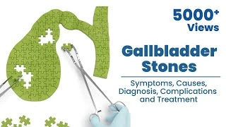 gallbladder-stones-myths-by-general-surgeons-in-bangalore-youtube-thumb